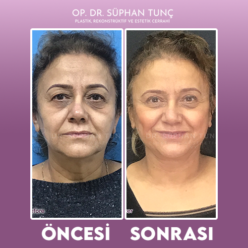 before-after