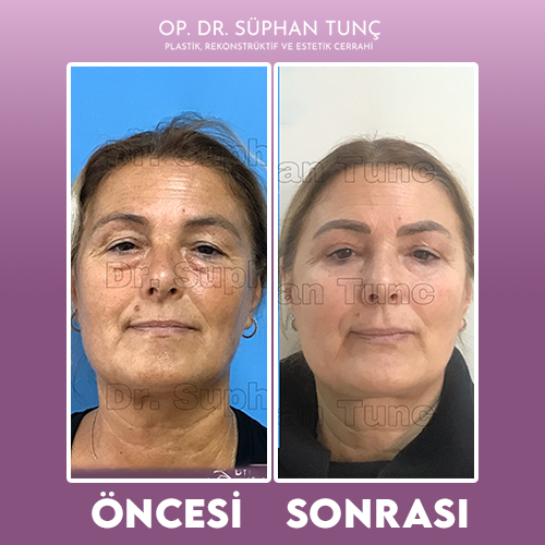 before-after