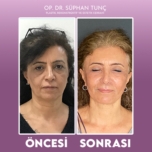 before-after