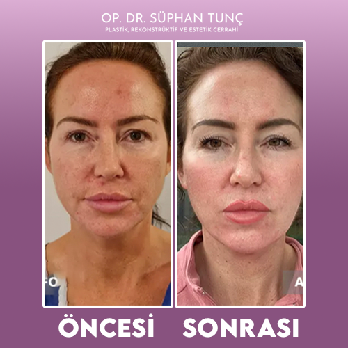 before-after