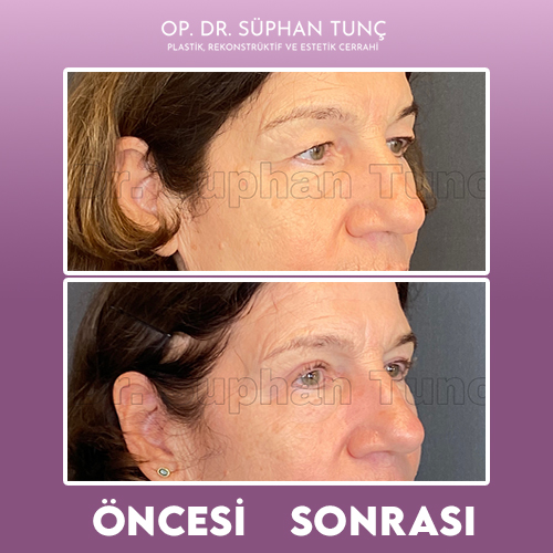 before-after