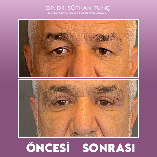 before-after