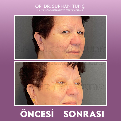 before-after