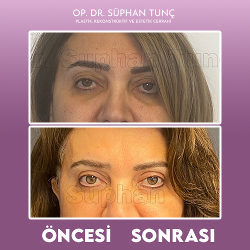 before-after
