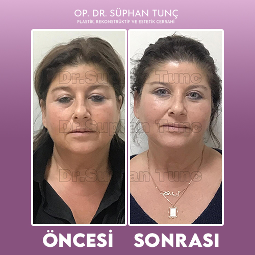 before-after