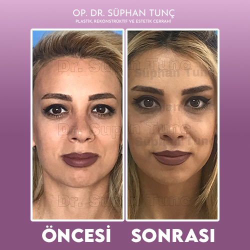 before-after
