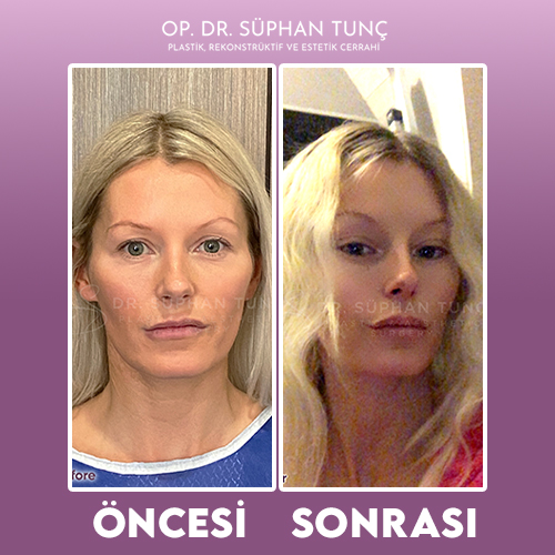 before-after