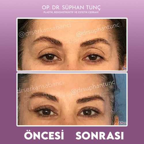 before-after