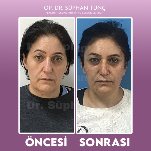 before-after