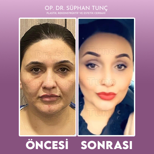 before-after