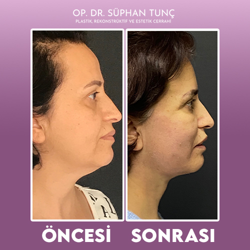 before-after