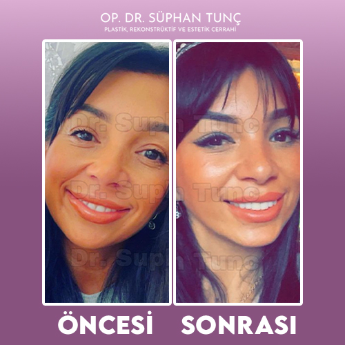 before-after