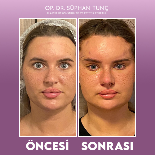 before-after