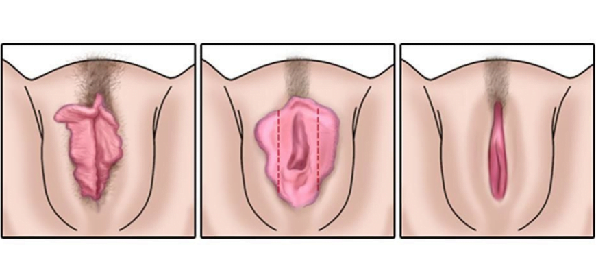 Labiaplasty