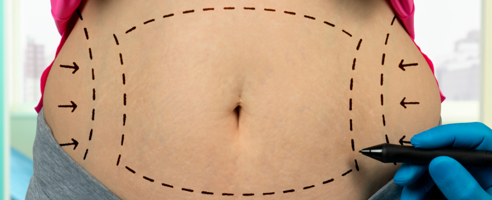 Liposuction