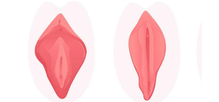 Vaginoplasty